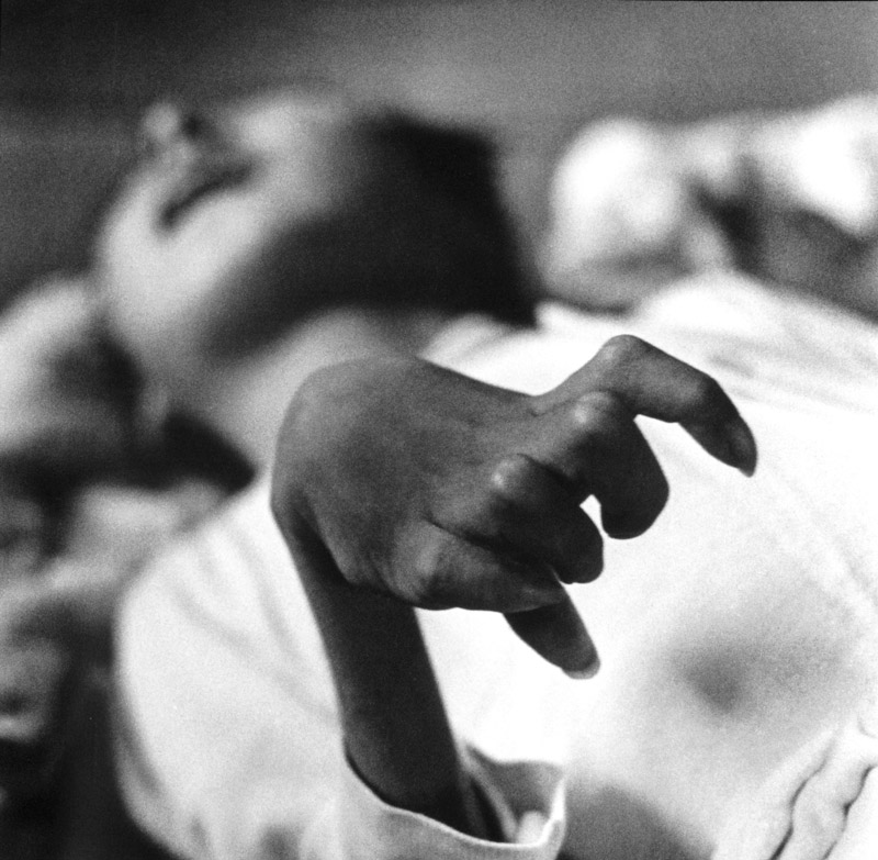 Detail of the hands of a victim of Minamata Disease, W. Eugene Smith. Not staged, but possibly "worked" quite heavily in the darkroom.